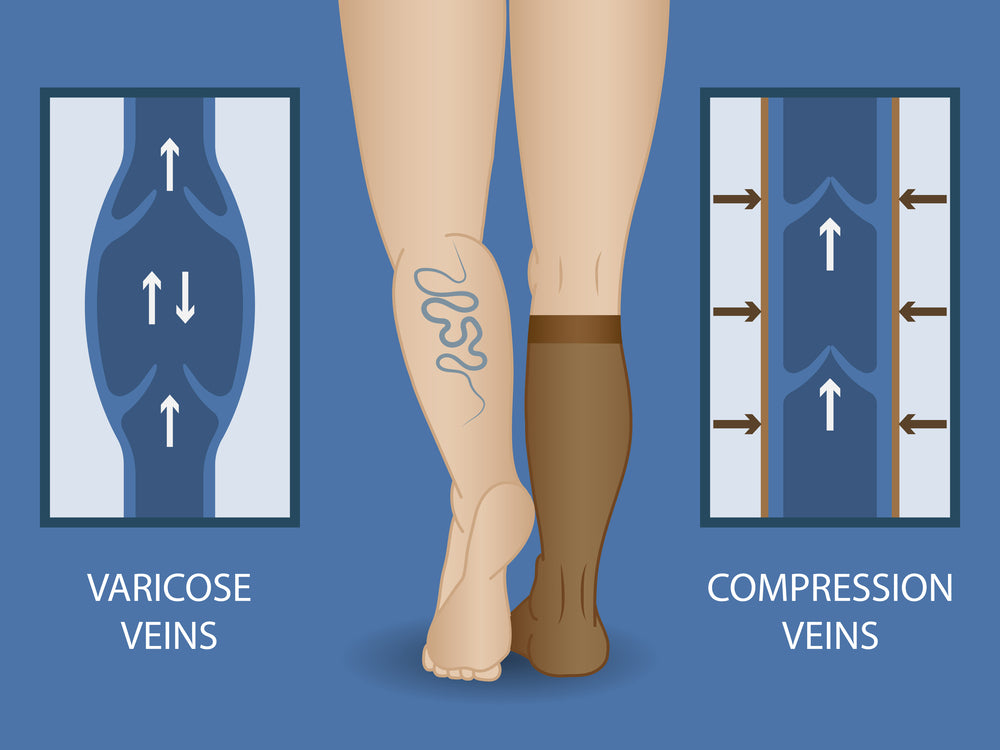 ¿Como me ayudan las calcetas de compresion?
